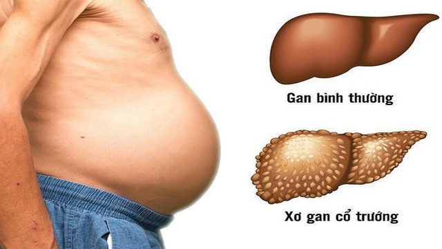 bai-viet/benh-xo-gan-co-truong-co-lay-khong.html