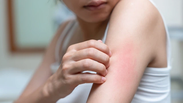 Bị viêm gan B có gây ngứa không? Cách giảm ngứa hiệu quả