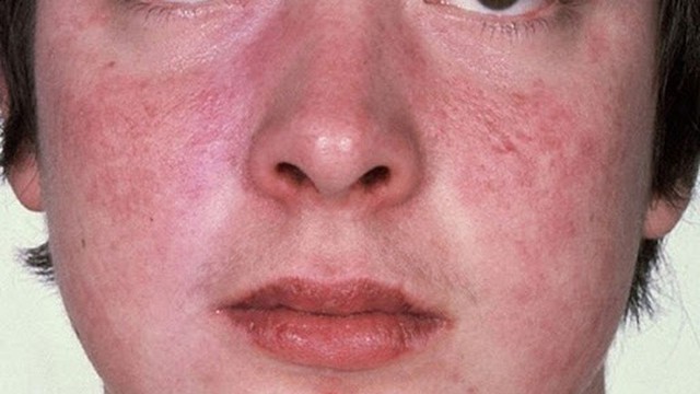 bai-viet/bieu-hien-va-giai-phap-dieu-tri-lupus-ban-do-o-nam-gioi-55851.html