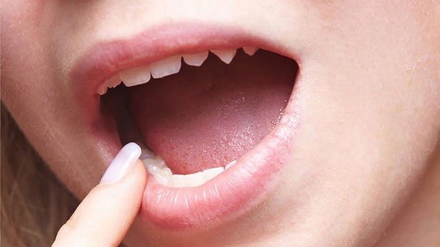 bai-viet/canh-bao-cac-dau-hieu-ung-thu-mieng-khong-nen-bo-qua.html