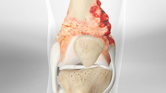 bai-viet/cac-giai-doan-cua-sarcoma-xuong-o-tre-em-va-thanh-thieu-nien-62027.html