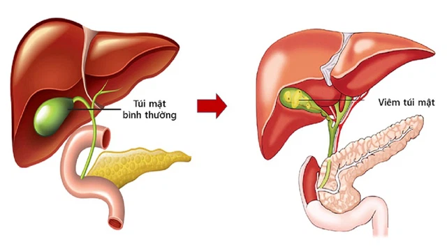 bai-viet/cac-muc-do-viem-tui-mat-cap-tinh-va-bien-phap-chan-doan-benh.html