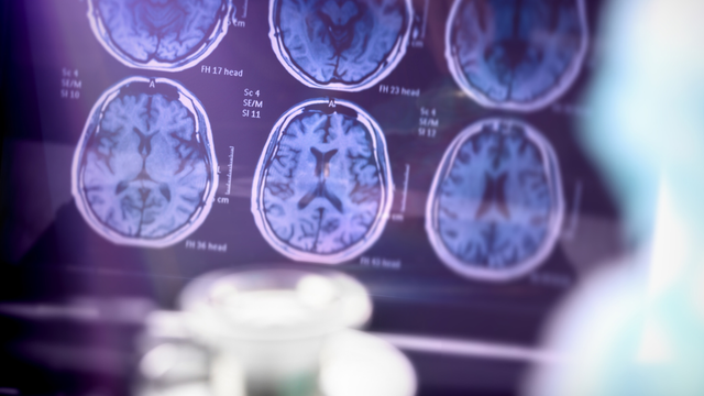 bai-viet/cac-nha-khoa-hoc-kham-pha-ra-cach-virus-herpes-gay-ra-benh-alzheimer.html