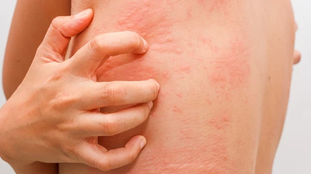 bai-viet/het-noi-me-day-hieu-qua-voi-dung-dich-xit-ngoai-da-skin-herbal.html