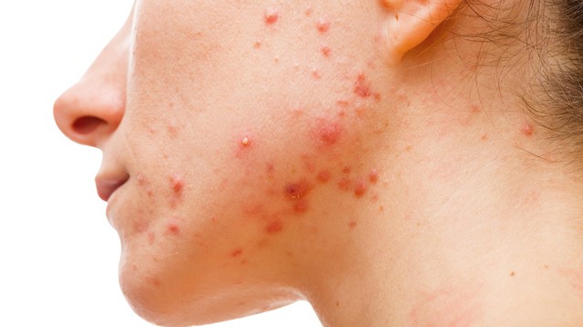 bai-viet/tong-hop-7-cach-lam-gel-nha-dam-tri-mun.html