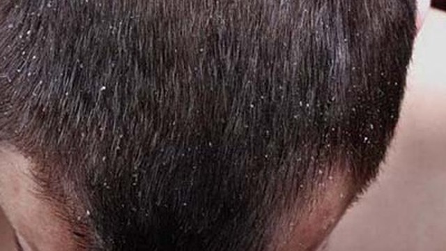 bai-viet/cach-tri-gau-hieu-qua-cho-nam-va-mot-so-luu-y-59368.html
