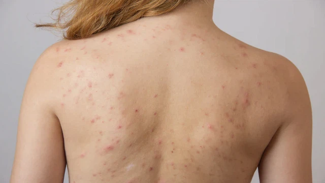 bai-viet/cach-tri-mun-lung-tai-nha-don-gian-hieu-qua-va-de-ap-dung.html
