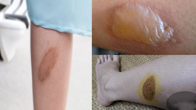 bai-viet/cach-xu-ly-khi-vet-bong-bo-xe-may-bi-phong.html