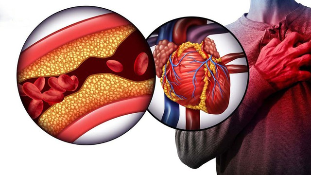 bai-viet/can-thiep-mach-vanh-la-gi-cac-chi-dinh-can-can-thiep-mach-vanh.html