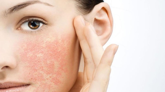 bai-viet/can-trong-da-nhiem-corticoid-nhan-biet-dau-hieu-va-cach-phuc-hoi.html