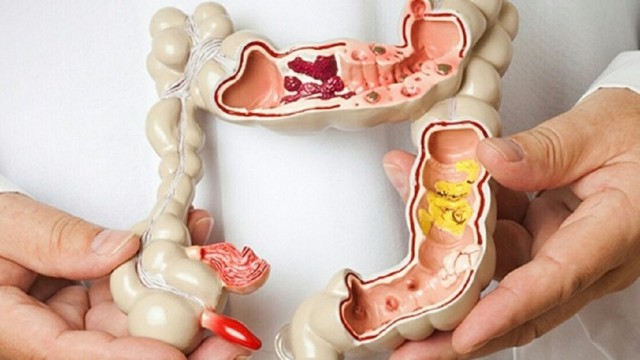 bai-viet/cat-polyp-dai-trang-va-nhung-dieu-ban-can-biet.html