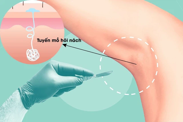 bai-viet/cat-tuyen-mo-hoi-nach-co-dau-khong-nhung-dieu-can-luu-y-khi-cat-tuyen-mo-hoi-nach.html