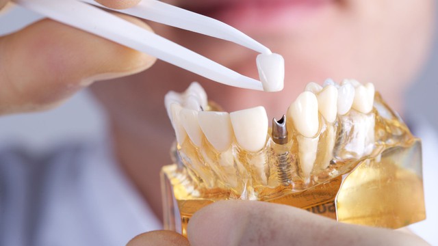 bai-viet/cay-implant-rang-cua-la-gi-co-dau-khong-va-mat-bao-lau.html