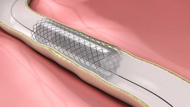 bai-viet/chi-phi-dat-stent-mach-canh-la-bao-nhieu.html