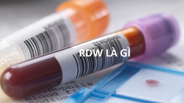 bai-viet/chi-so-xet-nghiem-rdw-la-gi-va-can-luu-y-gi-khi-thuc-hien-xet-nghiem-rdw-67693.html