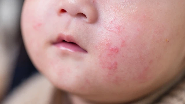 Chữa nấm da ở trẻ sơ sinh như thế nào là đúng cách?
