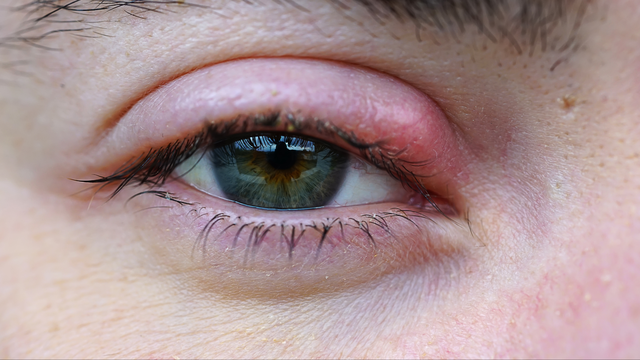 bai-viet/chich-leo-mat-tai-nha-duoc-khong-phuong-phap-dieu-tri-leo-mat-an-toan.html