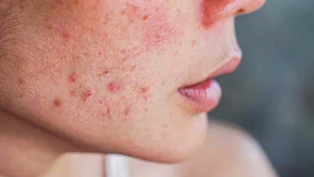 Da nhiễm corticoid có tiêm meso được không?