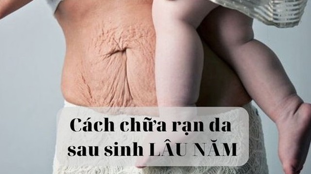 bai-viet/danh-gia-hieu-qua-tung-cach-chua-ran-da-sau-sinh-lau-nam-56797.html