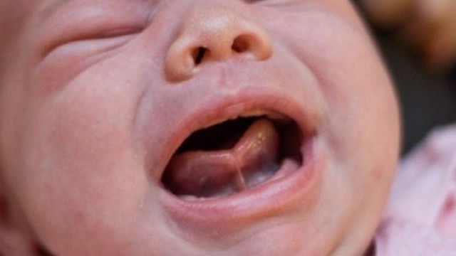 bai-viet/dau-hieu-phan-biet-luoi-binh-thuong-va-dinh-thang-luoi.html