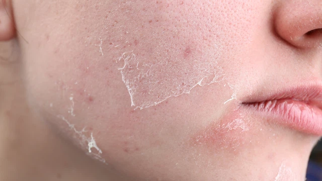 bai-viet/dung-retinol-bi-bong-da-trong-bao-lau-can-luu-y-nhung-gi-khi-su-dung.html