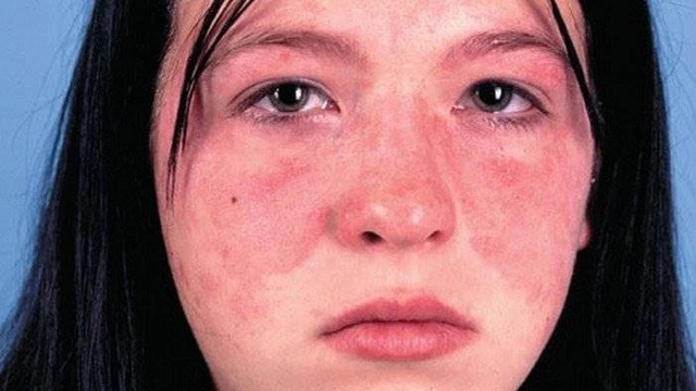 bai-viet/giai-dap-bi-benh-lupus-ban-do-he-thong-khi-mang-thai-co-sao-khong-56231.html
