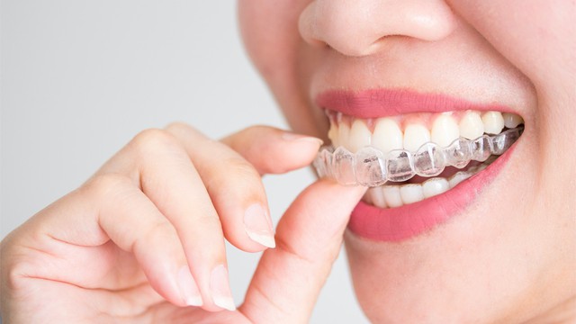 bai-viet/nieng-rang-invisalign-co-hieu-qua-khong-uu-va-nhuoc-diem.html