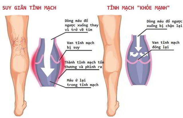 bai-viet/hay-kiem-tra-xem-co-the-ban-co-bi-gian-tinh-mach-khong-15633.html