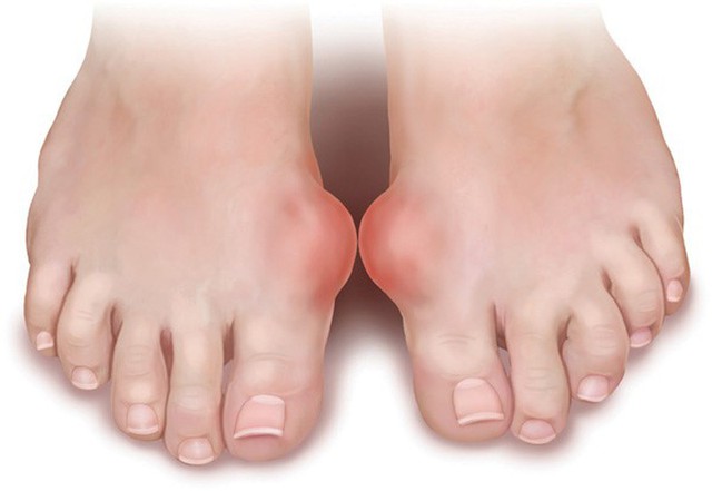 bai-viet/hinh-anh-benh-gout-va-cach-phong-tranh-benh-gout-45083.html