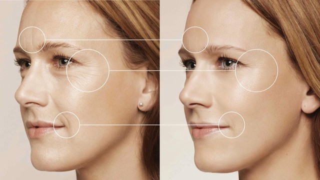 Hình ảnh căng da mặt bằng chỉ: Hiệu quả sau 1 liệu trình