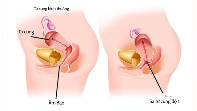 bai-viet/hinh-anh-sa-tu-cung-do-1-dau-hieu-nhan-biet-va-cach-tri.html