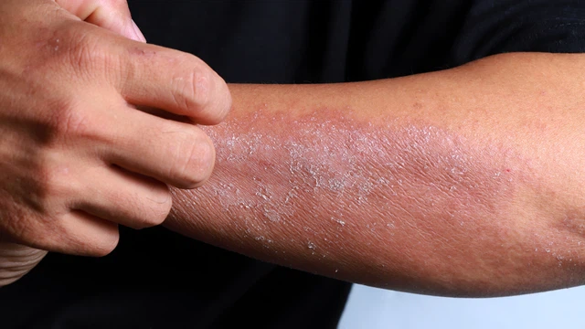 Hình ảnh viêm da cơ địa người lớn: Nguyên nhân và cách điều trị 0