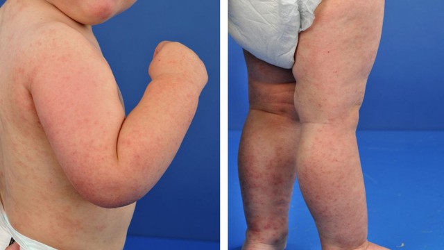 bai-viet/hoi-chung-gianotti-crosti-benh-ly-ve-da-hiem-gap-o-tre-em-cha-me-can-biet.html