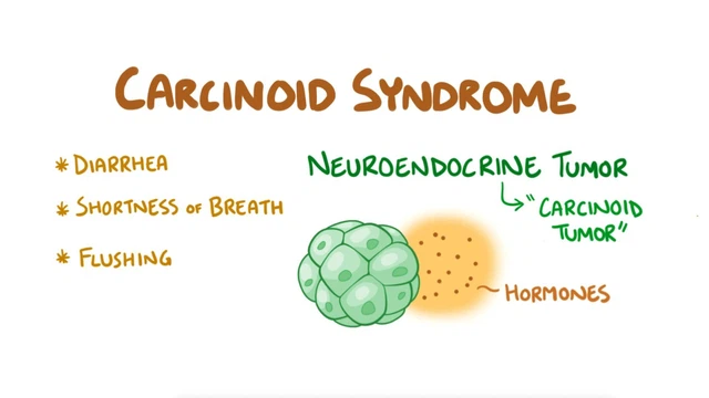 benh/hoi-chung-carcinoid.html