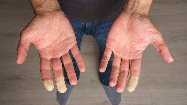 benh/hoi-chung-raynaud-632.html