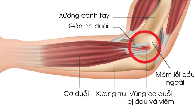 bai-viet/hoi-chung-tennis-elbow-la-gi-cach-dieu-tri-hieu-qua-nhat.html