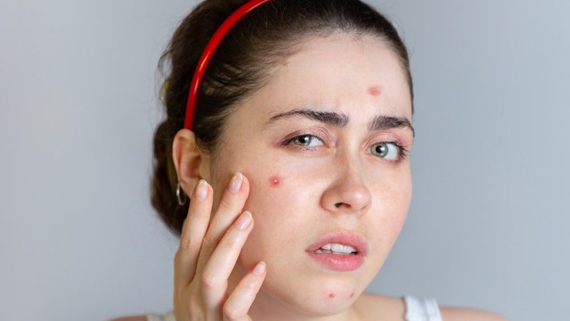bai-viet/isotretinoin-la-gi-tac-dung-phu-cua-isotretinoin-67906.html