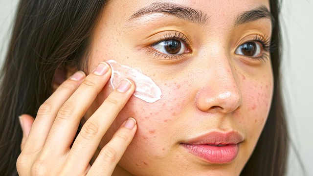 Top 10 kem chống nắng cho da mụn bạn nên thử
