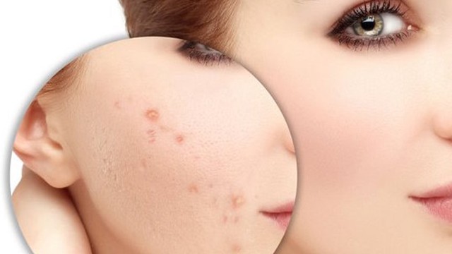 bai-viet/kem-tri-mun-decumar-va-acnes-cai-nao-tot-hon-58826.html