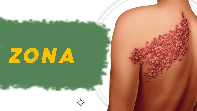 bai-viet/goi-y-5-loai-la-cay-chua-zona-than-kinh-an-toan-tai-nha.html