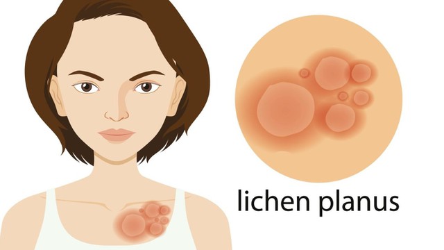 benh/lichen-phang.html
