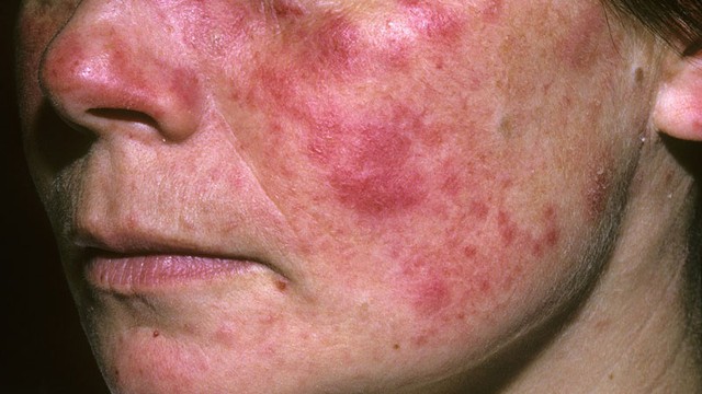 bai-viet/lupus-ban-do-co-ngua-khong-cach-nhan-biet-lupus-ban-do-55543.html