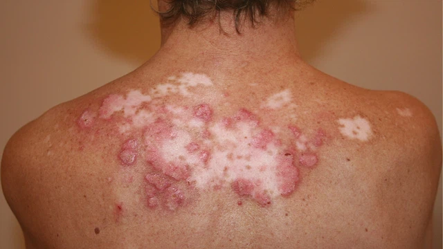 benh/lupus-ban-do-dang-dia.html