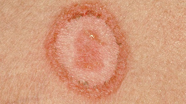 bai-viet/lupus-ban-do-dang-dia-co-ngua-khong-57278.html