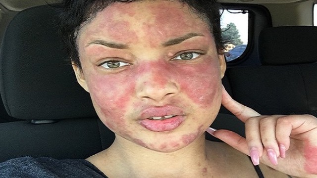 bai-viet/lupus-ban-do-mien-dich-co-nguy-hiem-khong-lam-sao-de-giam-cang-thang-khi-mac-benh-56391.html