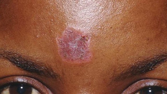 bai-viet/lupus-ban-do-o-mat-co-cac-dang-ton-thuong-nao-56414.html