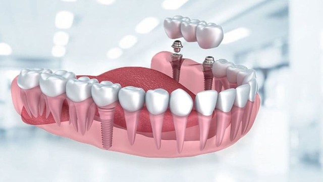 bai-viet/megagen-implant-la-gi-co-uu-diem-gi-so-voi-cac-loai-implant-khac.html