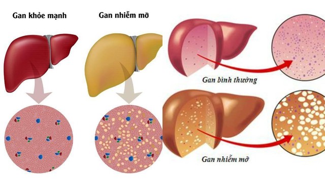 bai-viet/mot-so-bai-thuoc-chua-gan-nhiem-mo-trong-y-hoc-co-truyen.html