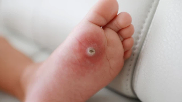 Làm sao để loại bỏ mụn cóc ở chân an toàn, hạn chế nguy cơ tái phát​?