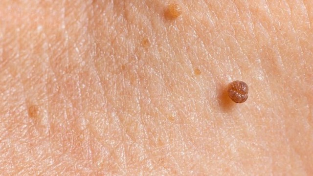 Mụn thịt có lây không? Cách ngăn mụn thịt phát triển